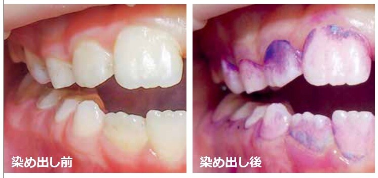 口腔内スキャナーで口腔内を検査する様子